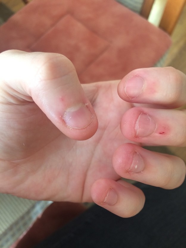help with skin picking